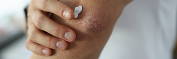 Creme für trockene Haut. Man cremt sich juckende Haut am Ellenbogen ein.