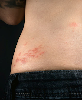 Gürtelrose (Herpes Zoster)