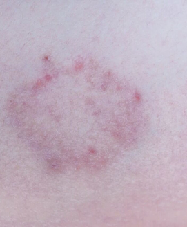 Hautpilz (Tinea)