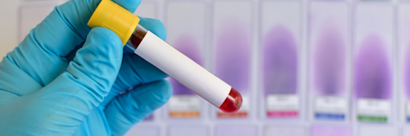 Eine Hand mit einem blauen Handschuh hält eine Blutprobe im Röhrchen.