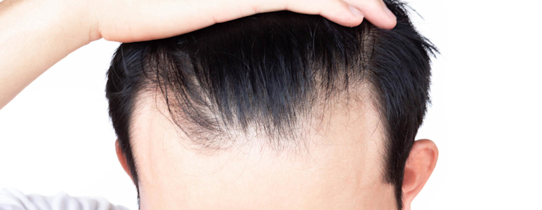 Ein Mann hält seinen Haaransatz nach hinten und es sind Geheimratsecken zu sehen.