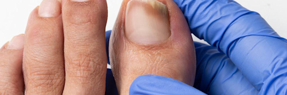 Nagelpilz (Onychomykoase): Fuß mit Zehen wird von Hand mit Handschuh gehalten. Dunkle Verfärbung am Nagel des großen Zehs.