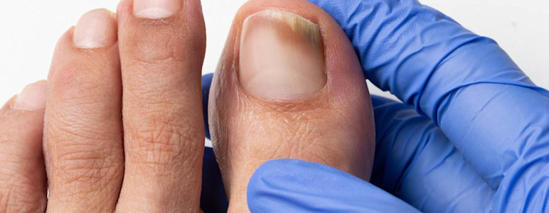 Nagelpilz (Onychomykoase): Fuß mit Zehen wird von Hand mit Handschuh gehalten. Dunkle Verfärbung am Nagel des großen Zehs.