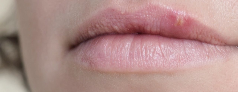 Frau mit Herpes an der Lippe.