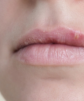 Lippenherpes