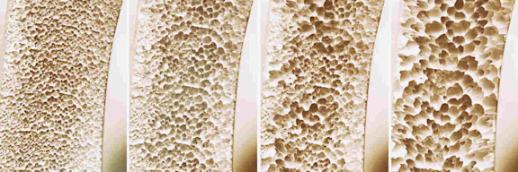 Knochenschwund in vier Phasen dargestellt.