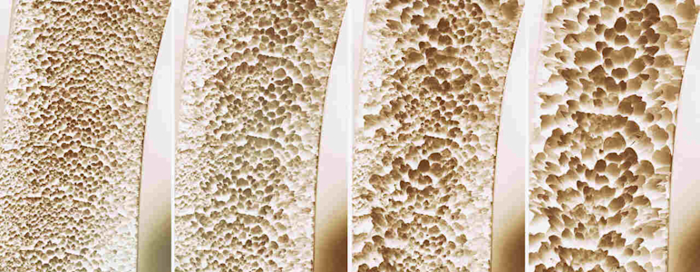 Knochenschwund in vier Phasen dargestellt.