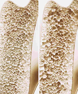 Osteoporose