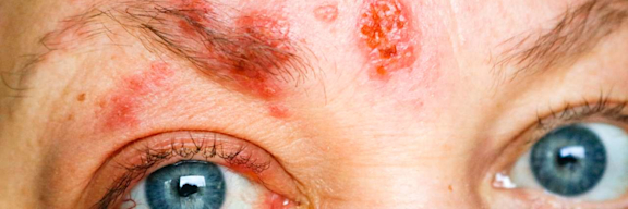 Gesichtsrose ist eine Gürtelrose (Herpes zoster) im Gesicht.