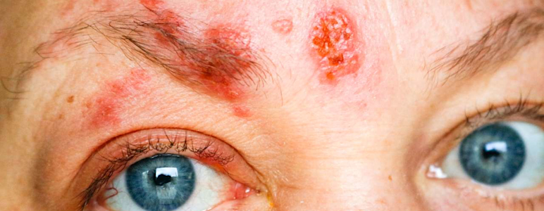 Gesichtsrose ist eine Gürtelrose (Herpes zoster) im Gesicht.