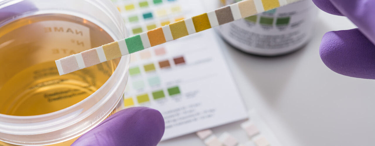Eine Urinprobe wird im Labor mittels Teststreifen analysiert.