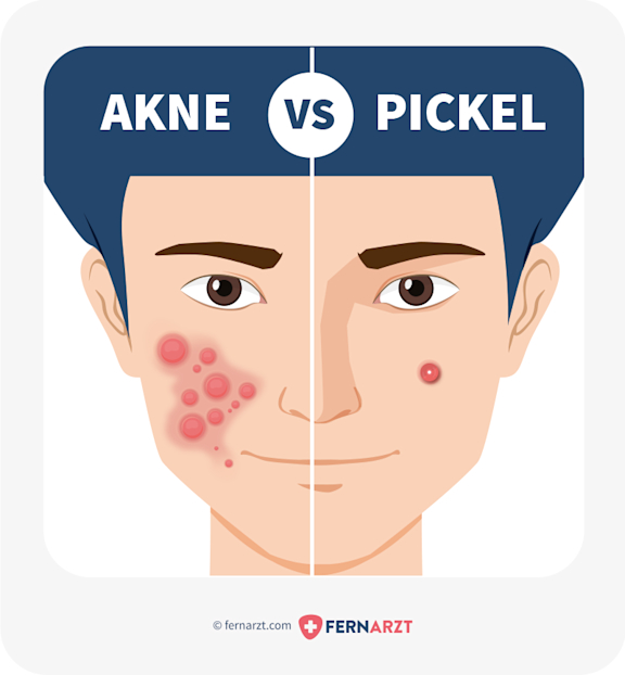 Grafik über den Unterschied zwischen Pickeln vs. Akne