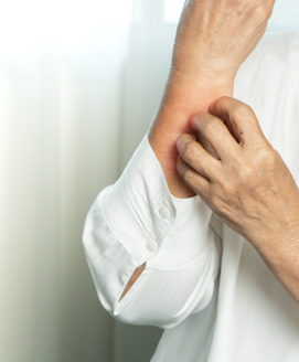 Nesselsucht (Urtikaria)