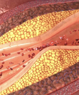 Erhöhtes Cholesterin