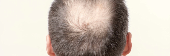 Mann mit lichtem Haar am Hinterkopf.