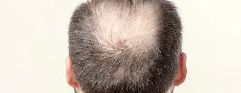 Mann mit lichtem Haar am Hinterkopf.