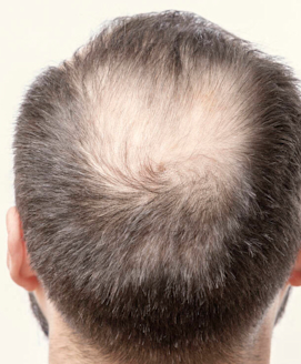 Haarausfall (Alopezie)