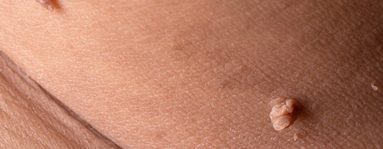 Haut mit Stielwarzen (weichem Fibrom)