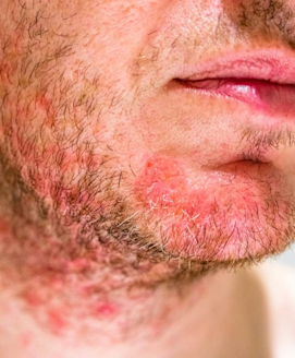 Seborrhoisches Ekzem