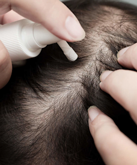 Was hilft gegen Haarausfall?