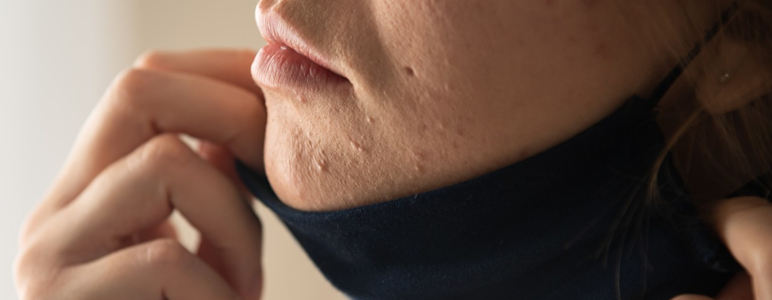Frau zieht FFP2-Maske herunter und enthüllt Akne.