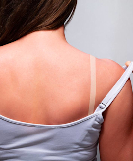 Sonnenbrand