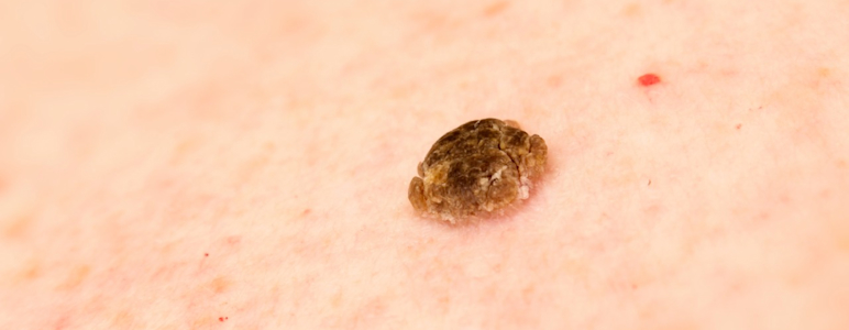 Haut mit Alterswarze (Seborrhoische Keratose)