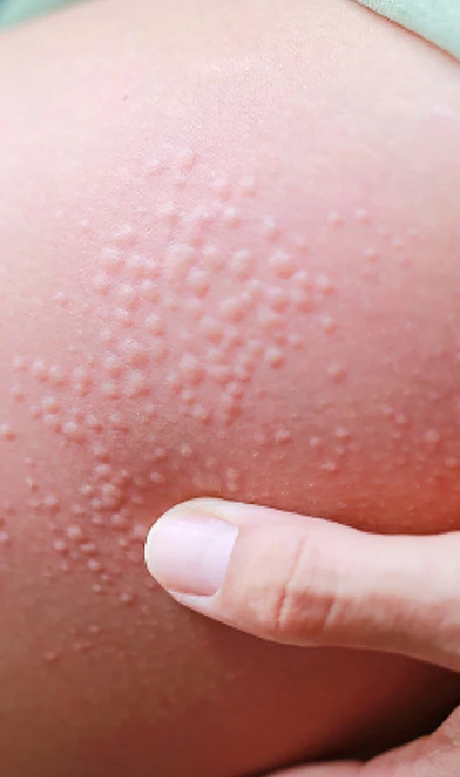 Skin with raised bumps being touched by a finger, indicating a possible skin condition or irritation.