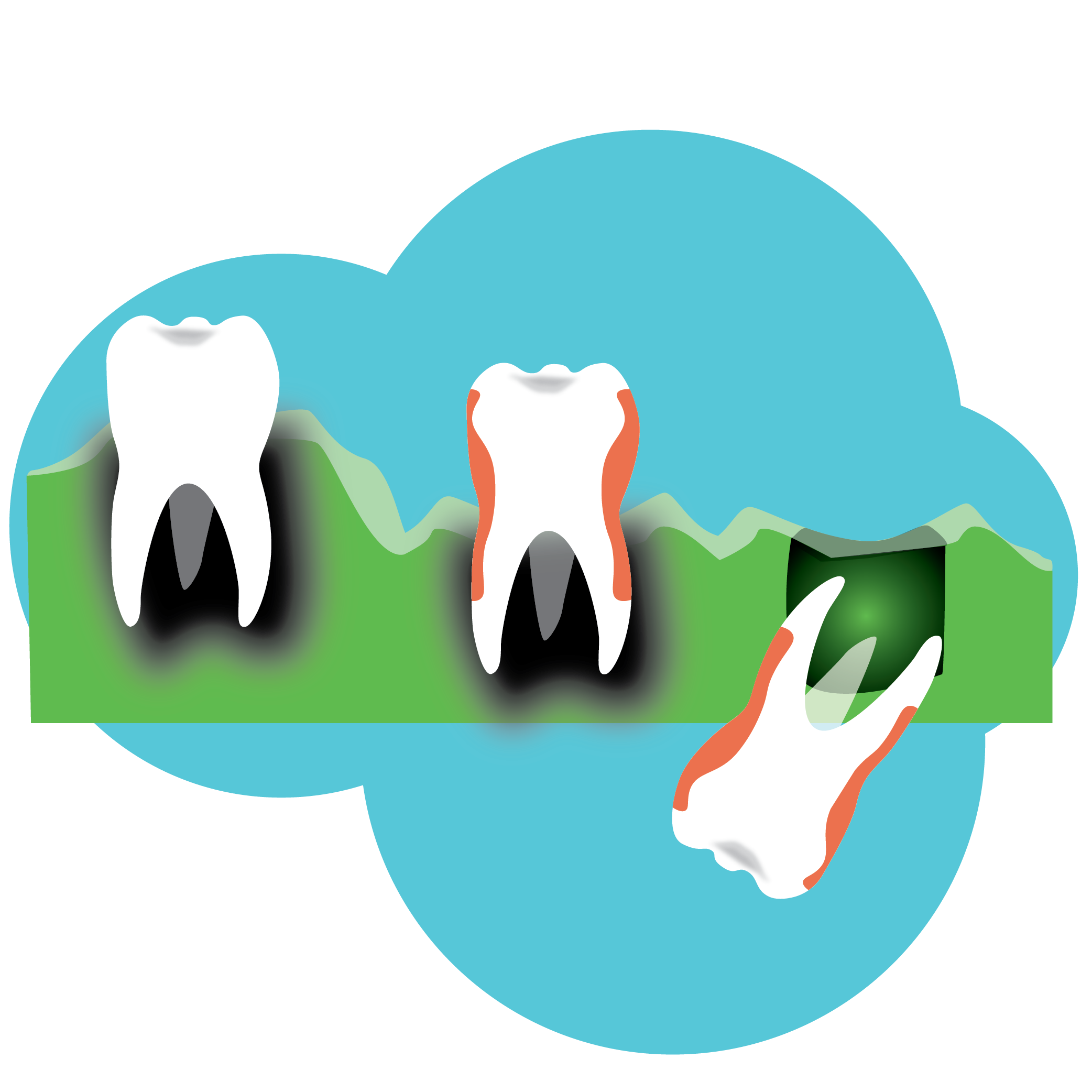 Illustration of 3 teeth next to one another in gums. One teeth is falling out
