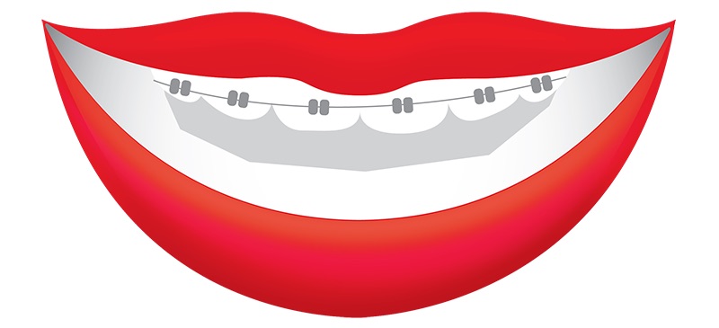 Graphic of mouth with braces