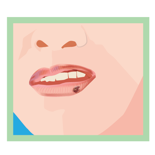 Illustration of the bottom half of someone's face from the nose down showing their mouth. Their lips are open revealing their top teeth. There is a cold sore on the bottom lip indicated by a red dot. 