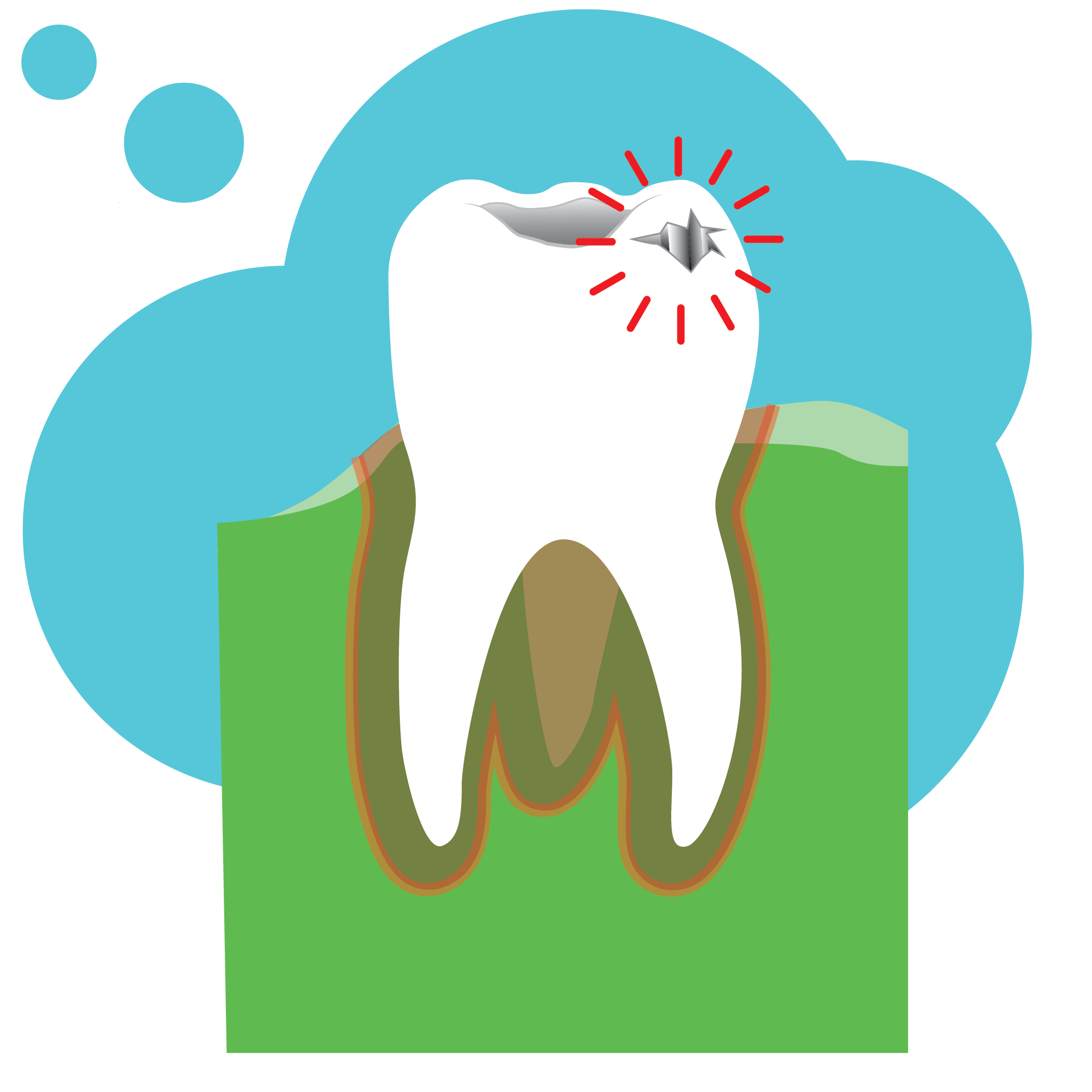 Illustration of tooth with decay/a cavity appearing on top as a gray hole in the tooth