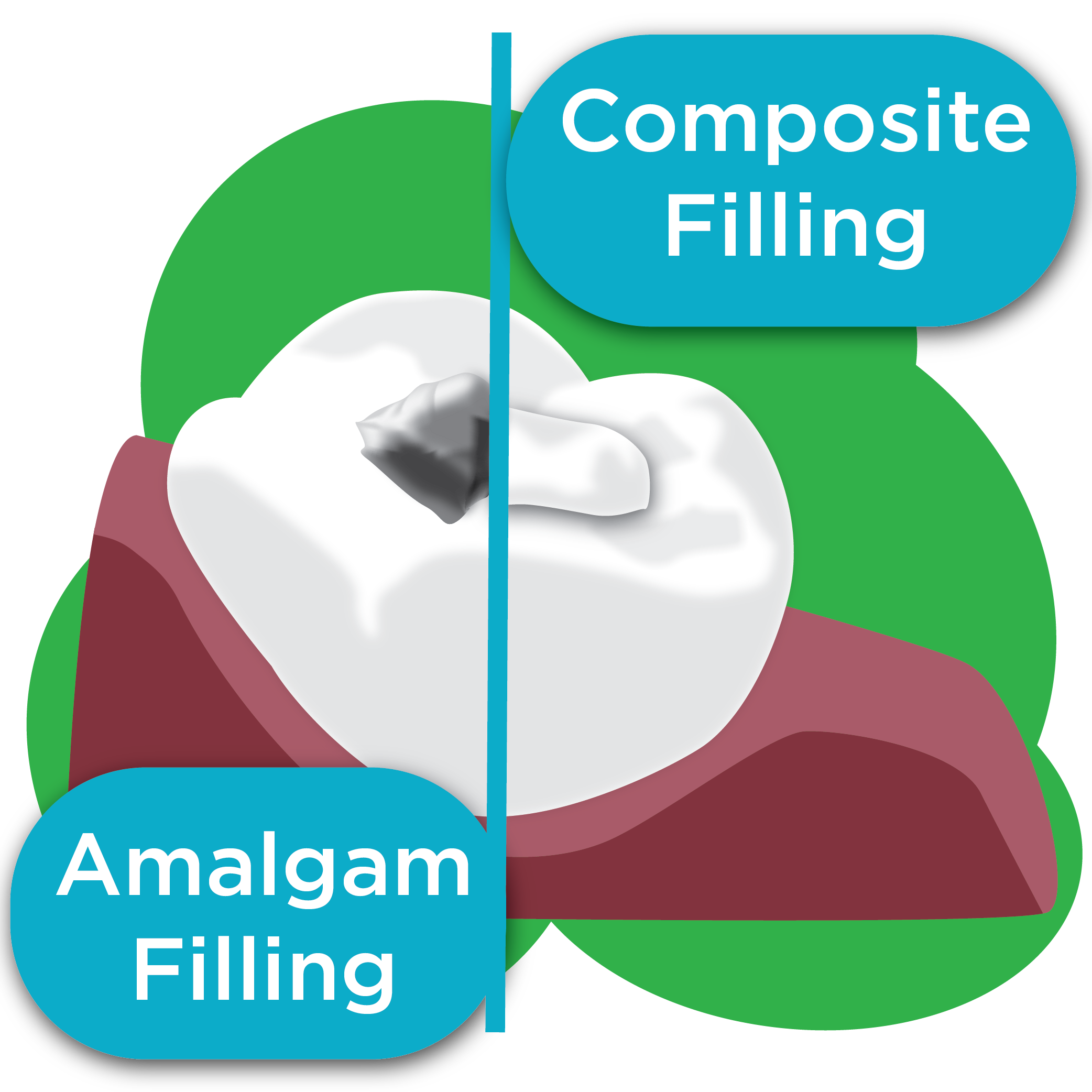 An illustration with a tooth divided by a line. One half of the tooth has an amalgam (silver) filling and the other side as composite resin (tooth colored) filling