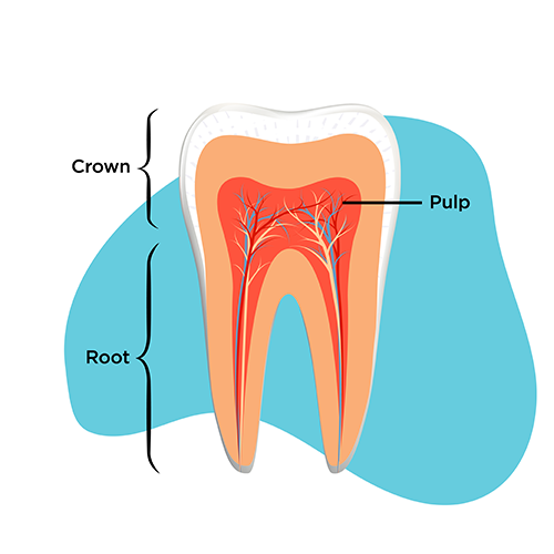 Illustration of a healthy tooth that shows the pulp inside, the root of the tooth and the crown. 