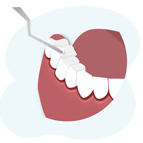Illustration of dental sealant being applied to surface of molars.