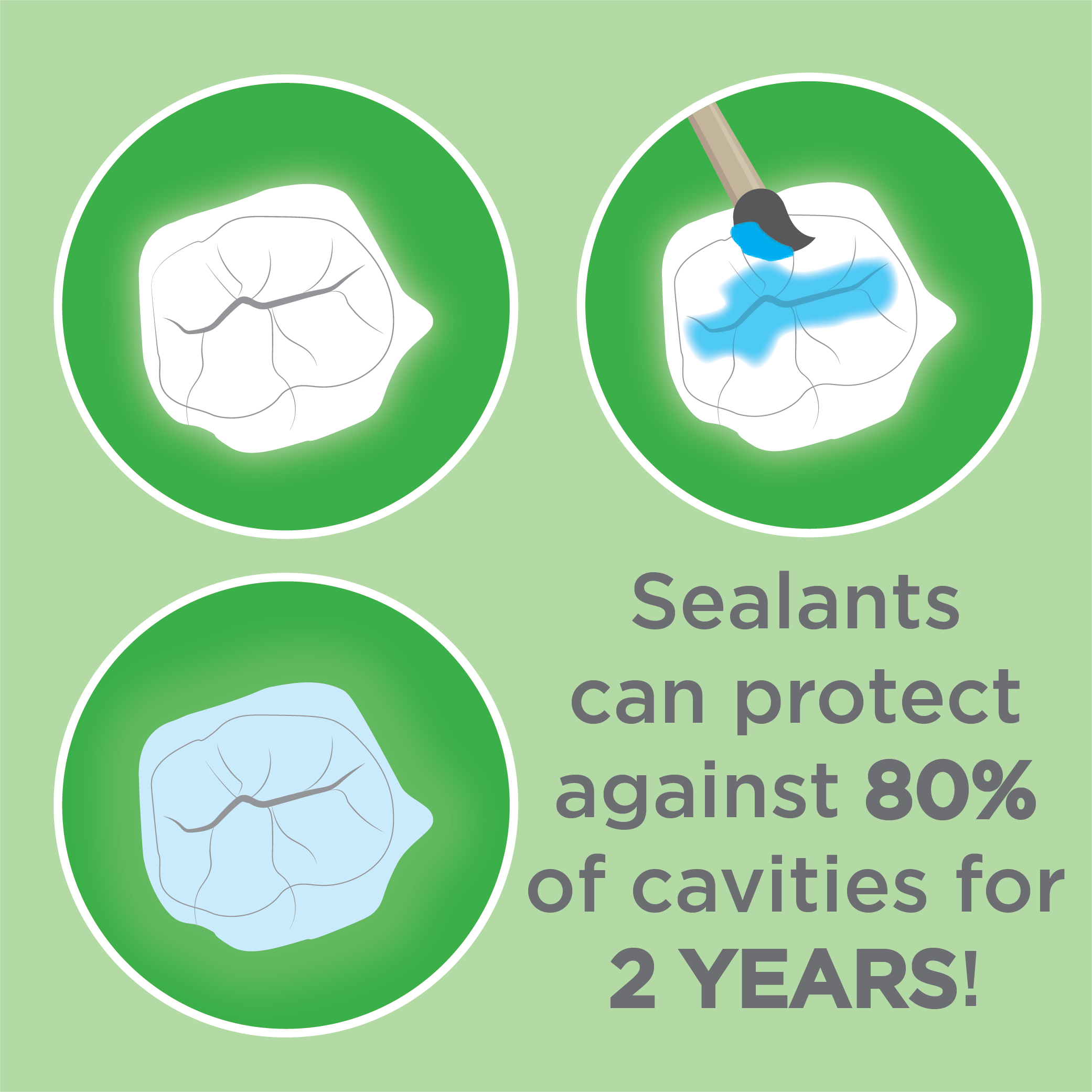 illustration depicting how dental sealants are applied to teeth