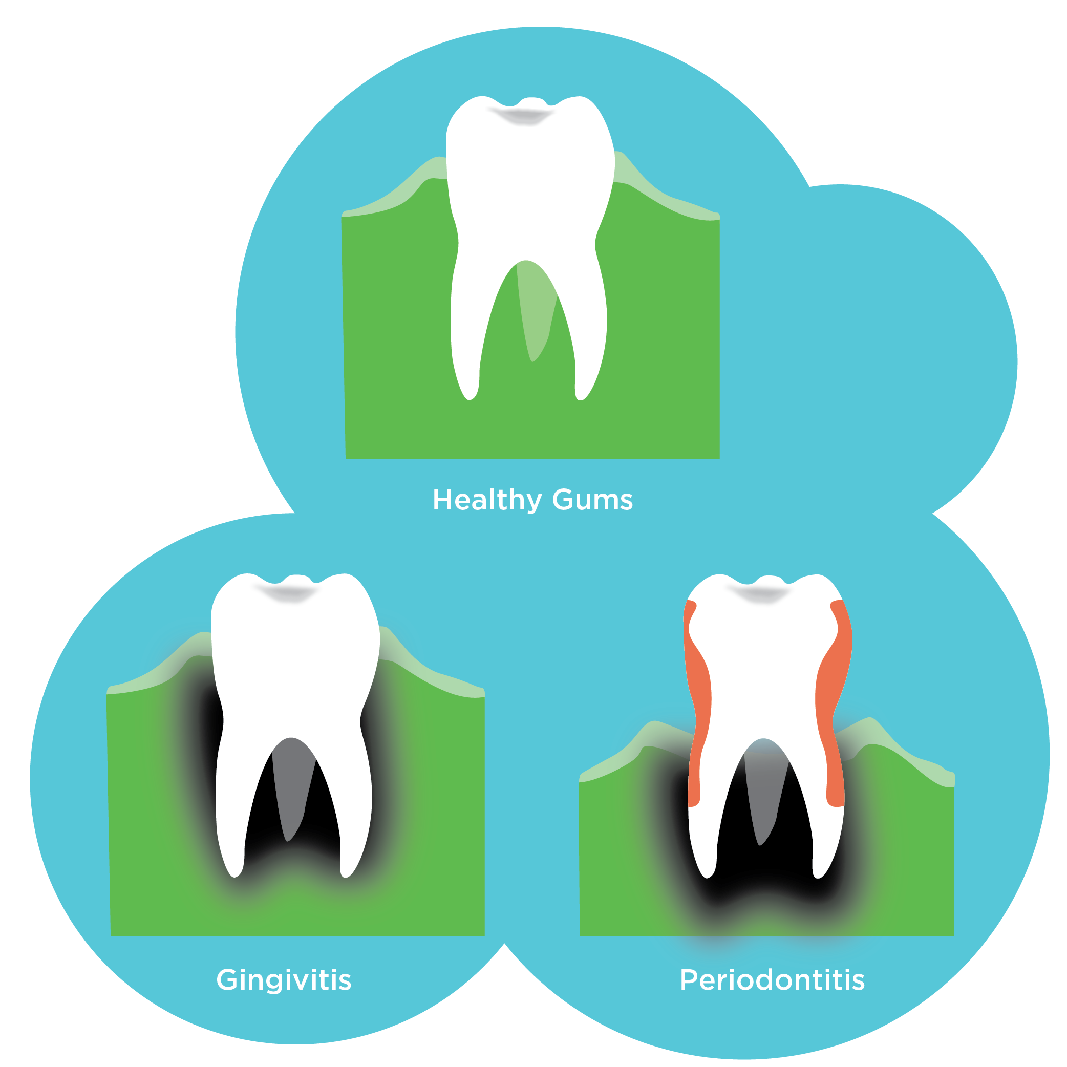 Illustrations of 3 teeth indicating healthy gums, gingivitis and periodontitis 