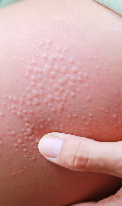 Pelle con protuberanze sollevate che vengono toccate con un dito, indicando una possibile condizione o irritazione della pelle.