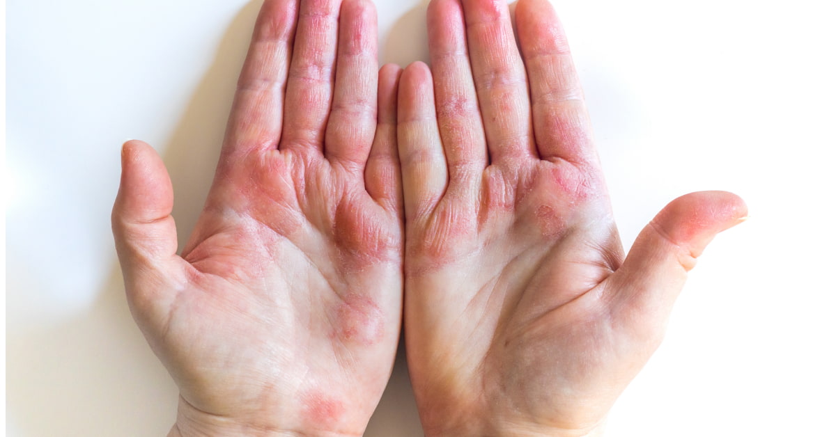 eczema
