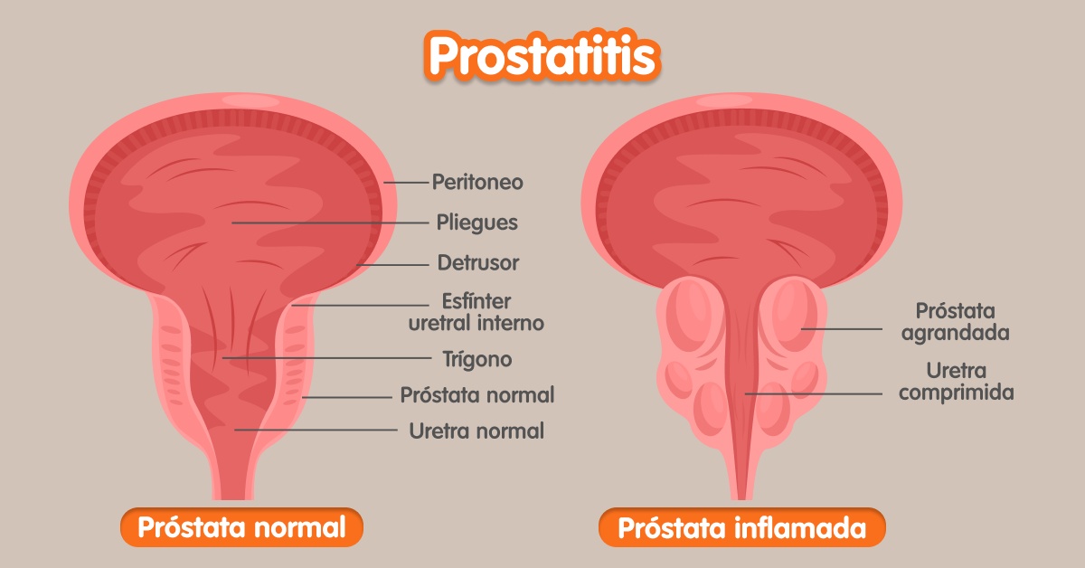 síntomasdelcáncerdepróstata img dos