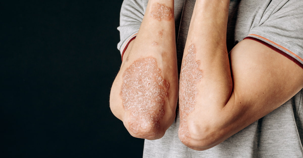 que es la psoriasis