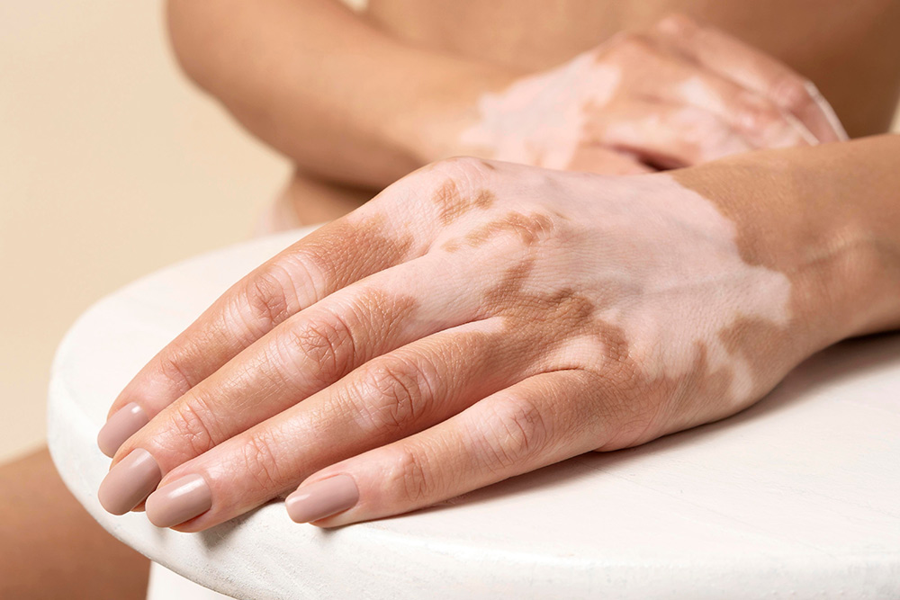 vitiligo 01