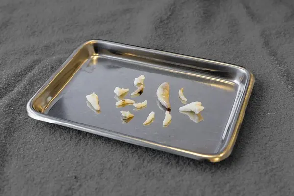 extracted teeth on a tray for article on stomatitis in cats extracted teeth on a tray for article on stomatitis in cats