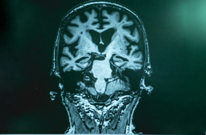 brain scan alzheimer's