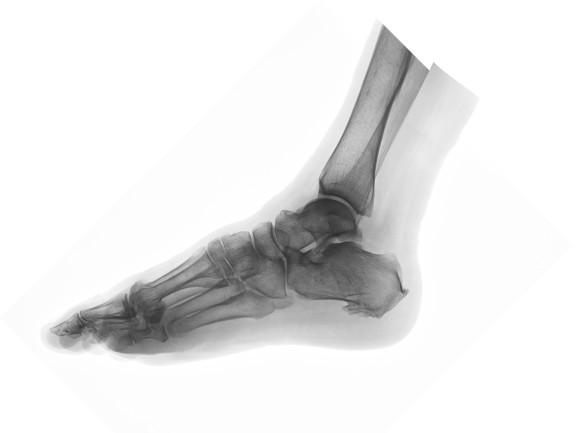 Foot X-ray - Shutterstock