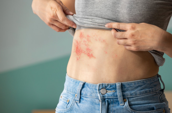 younger woman with shingles