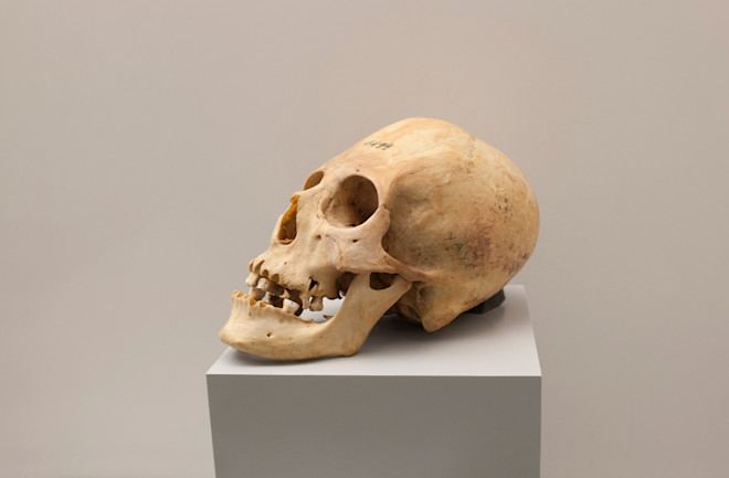 elongated skull