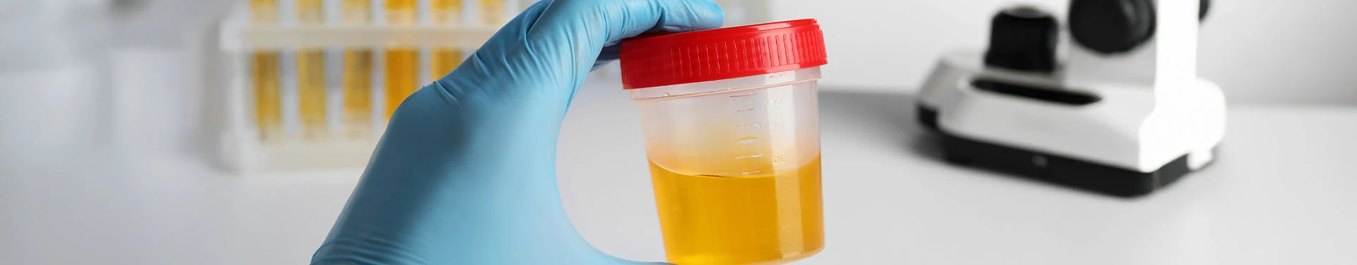 ¿Cómo es la orina de un diabético? - TENA