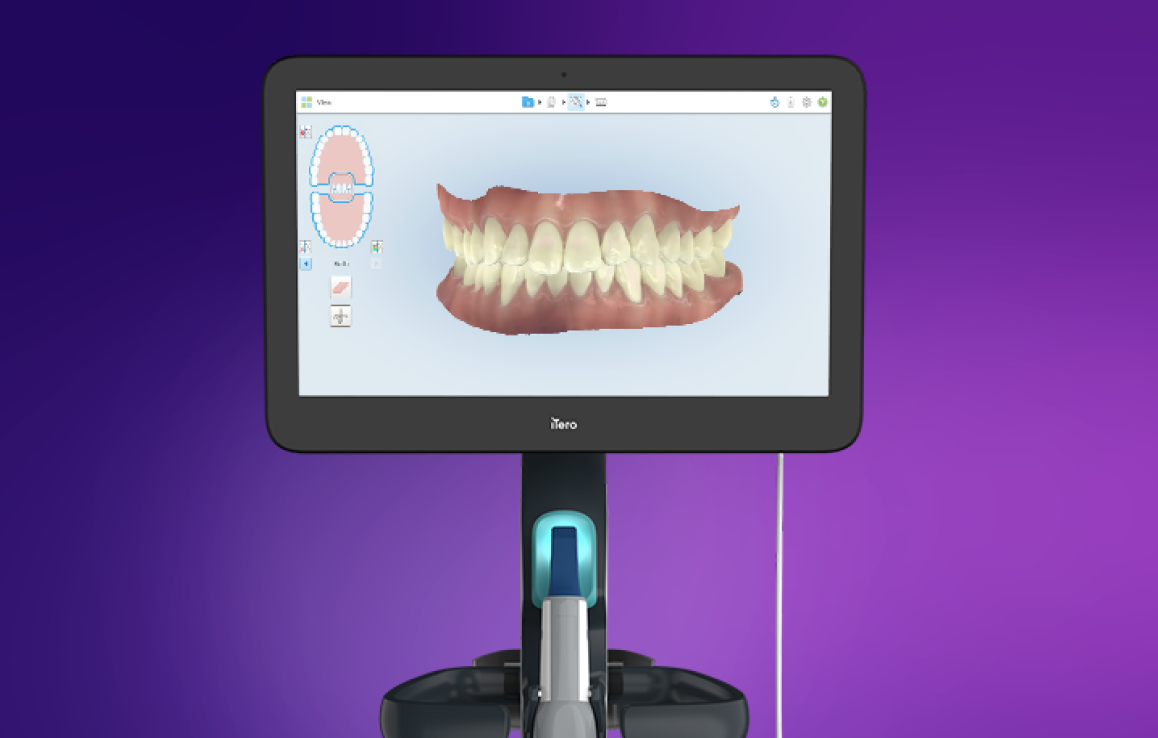 iTero scanner for restorative dentistry
