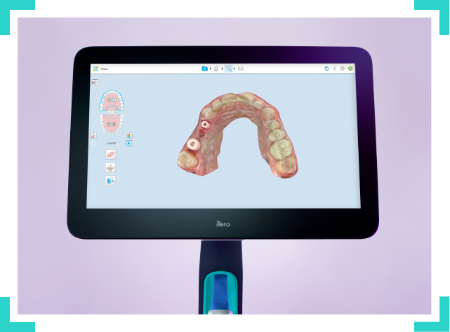 itero scanner